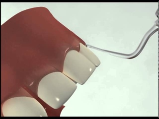 Minimally invasive surgical crown extension, using sonic tips according to Dr  Schwenk and Dr  Strie