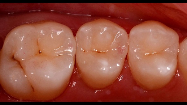 Кариес под микроскопом 2017 caries treatment under